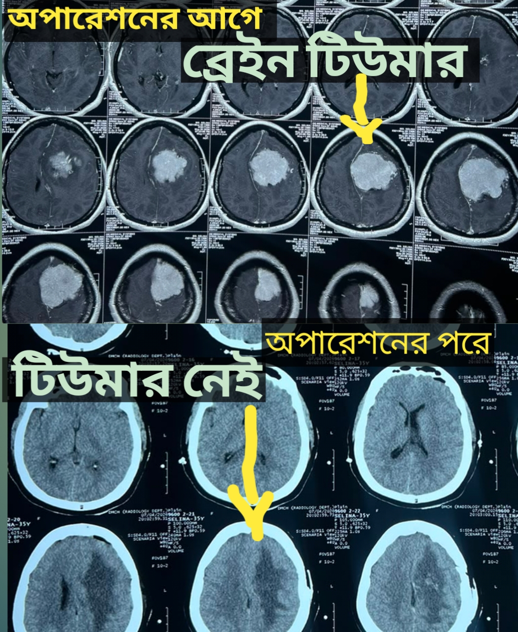 বিশাল ব্রেইন টিউমার অপারেশন। অসাধারণ সাফল্য