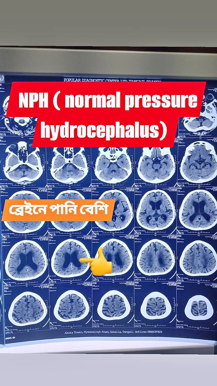 NPH.  Normal pressure hydrocephalus.  বয়স্ক মানুষের ব্রেইনে পানি বেশি