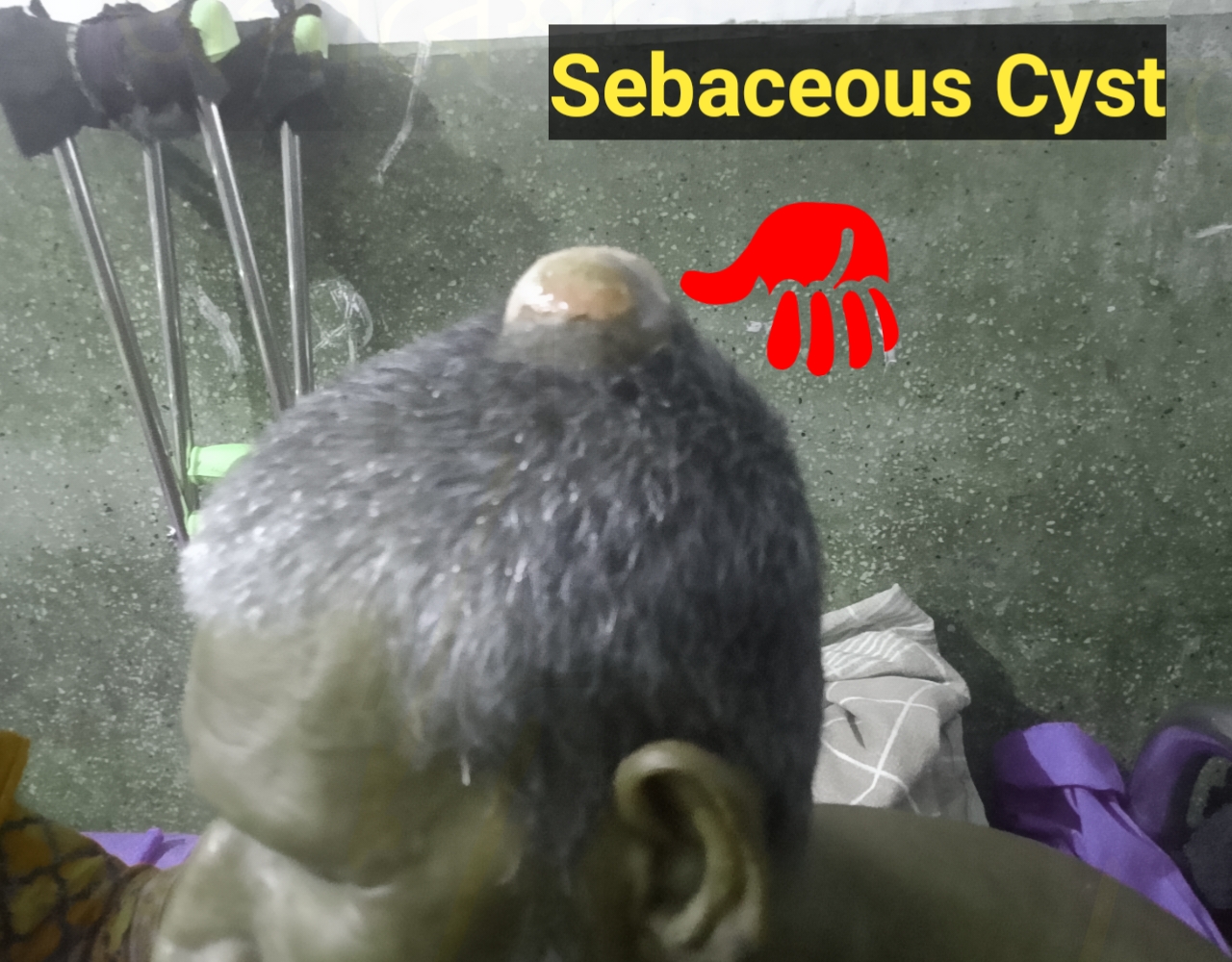 সেবাসিয়াস সিস্ট।।  sebaceous cyst