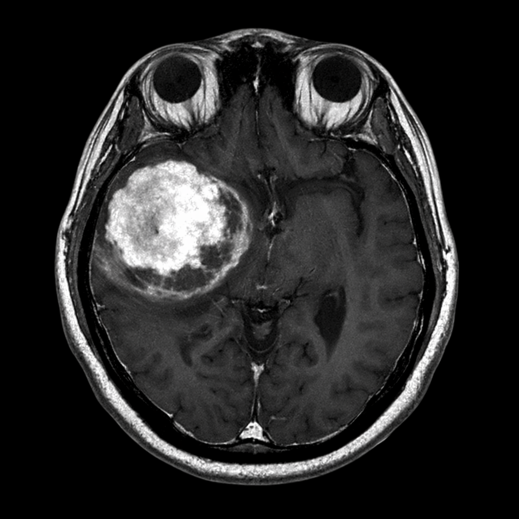 ব্রেইন টিউমার কি? কারণ, লক্ষণ ও আধুনিক চিকিৎসা পদ্ধতির বিস্তারিত আলোচনা
