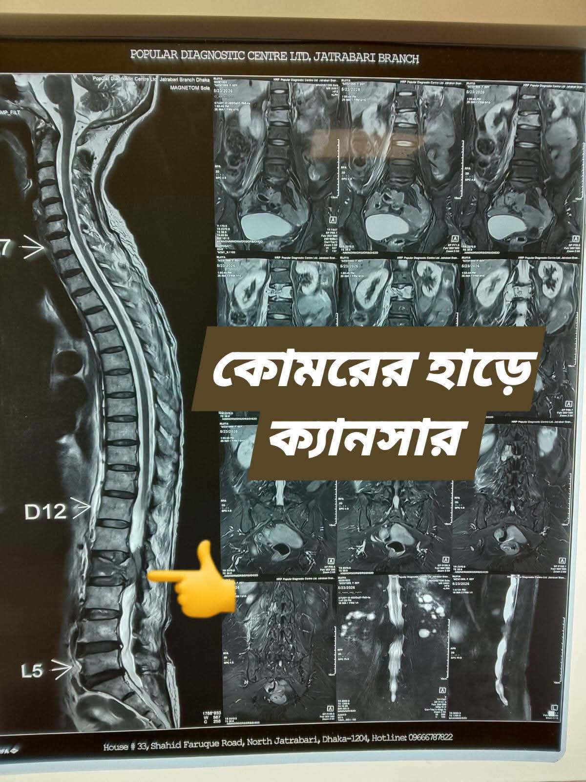 কোমরের হাড়ে ক্যানসার, সচেতনতা।  যা জানা জরুরি।